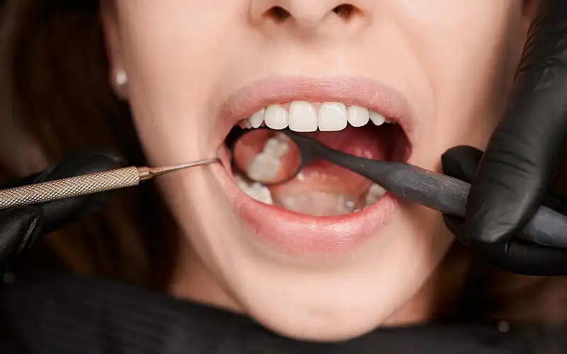 Sealants Protect Your Teeth from Cavities